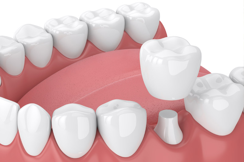 Dental Crowns in Taunton