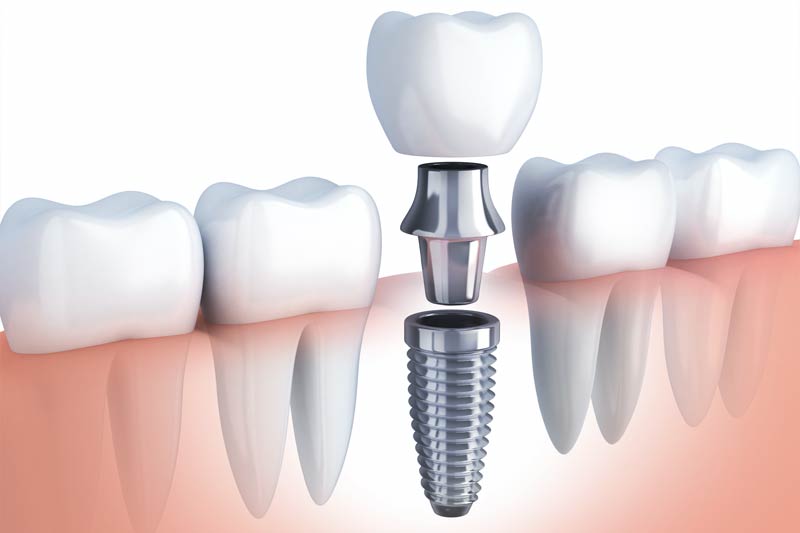 Implants Dentist in Taunton
