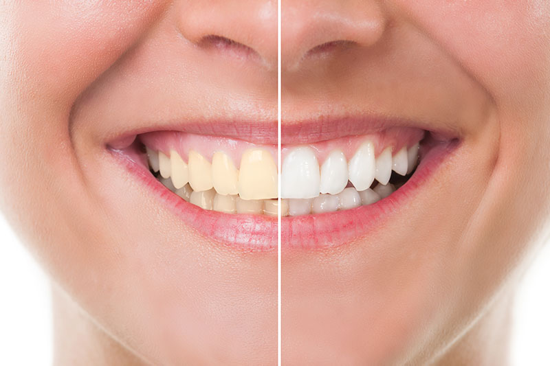 Teeth Whitening in Taunton