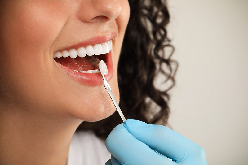 Veneers in Taunton